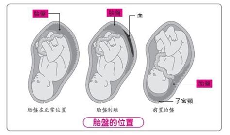 胎盤剝離預防|胎盤問題全解析